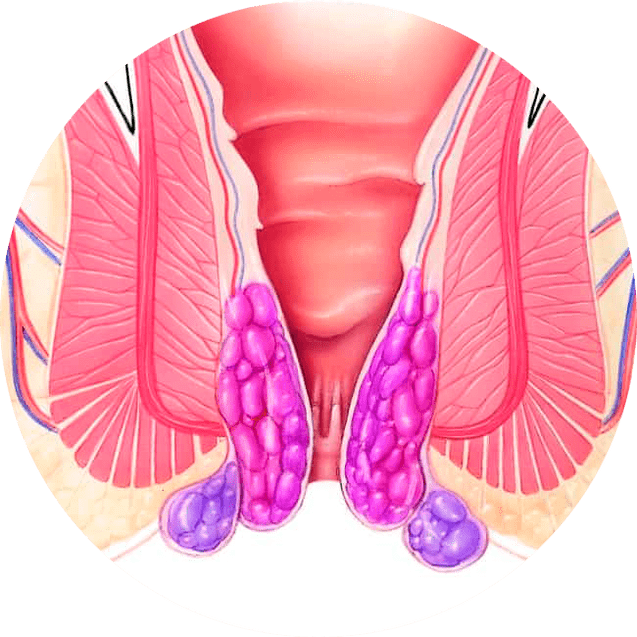 Gelarex lindert die Symptome bereits bei der ersten Anwendung